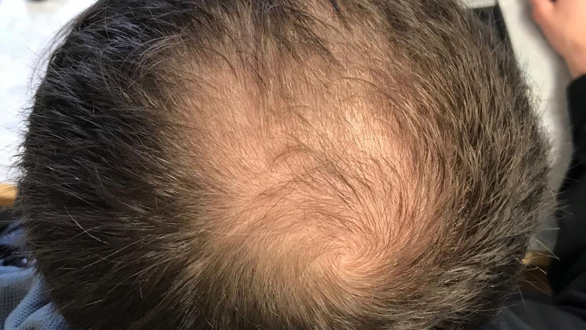 File:Male-pattern hair loss.jpg