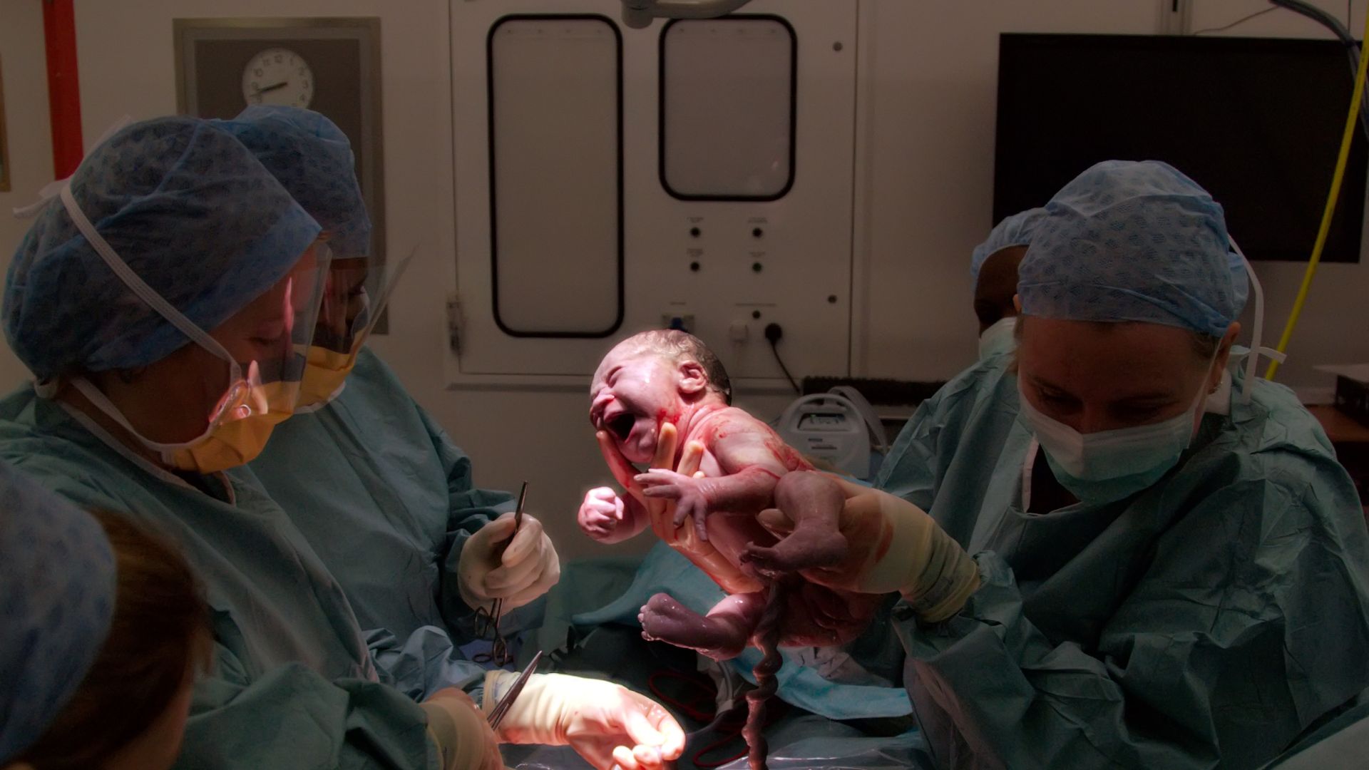 File:Cesarian the moment of birth3.jpg