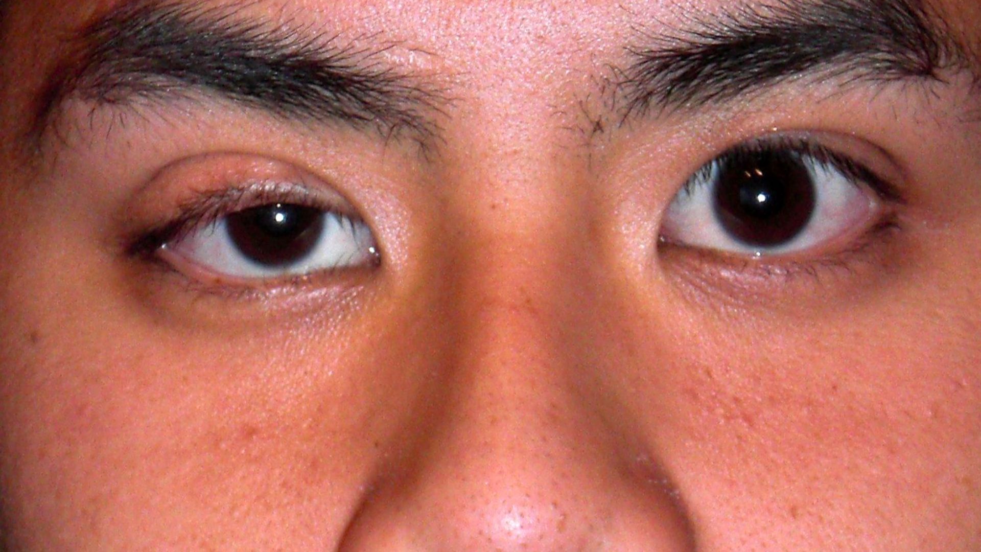File:Congenitalptosis.JPG