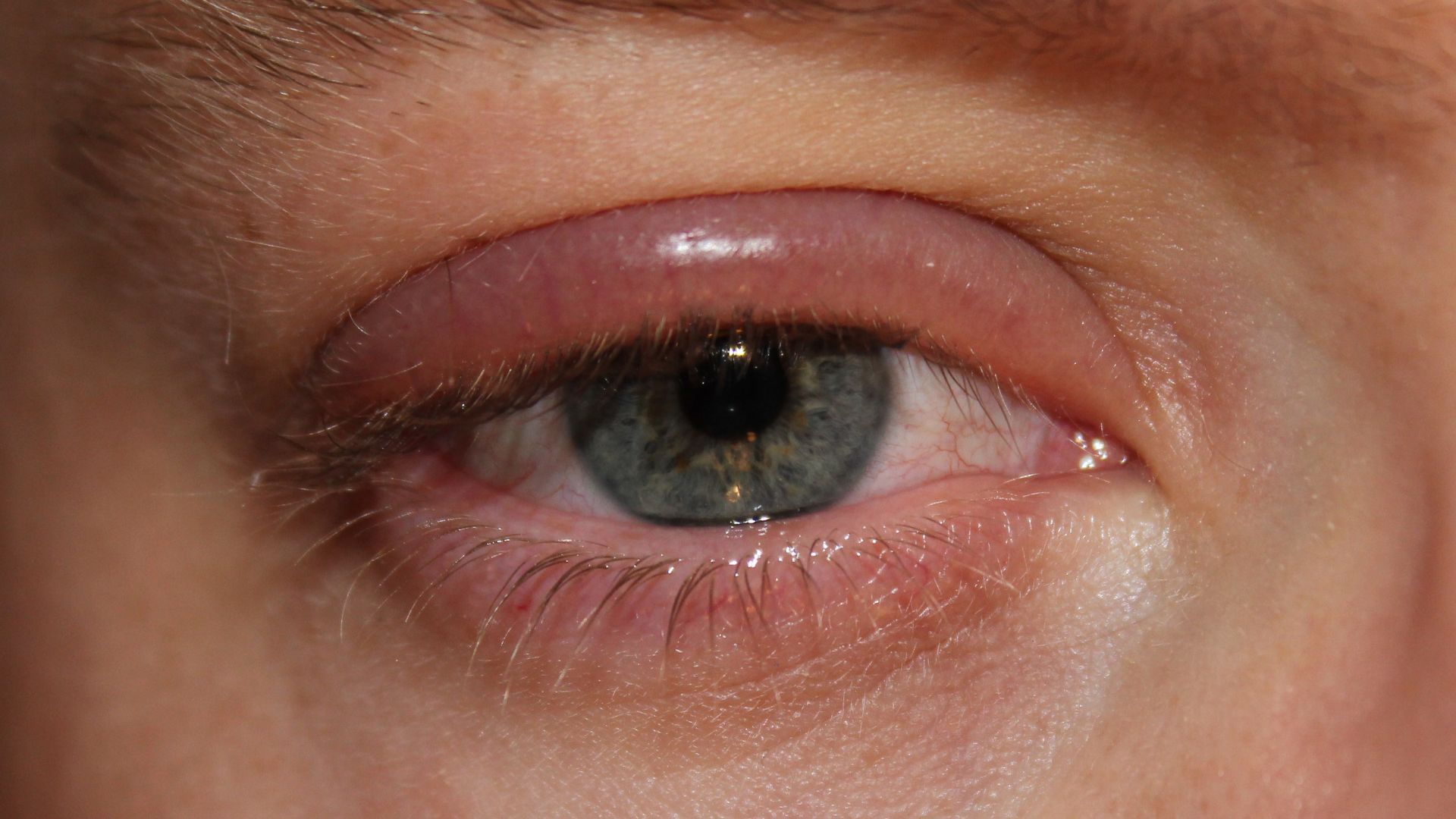 File:Blepharitis.JPG
