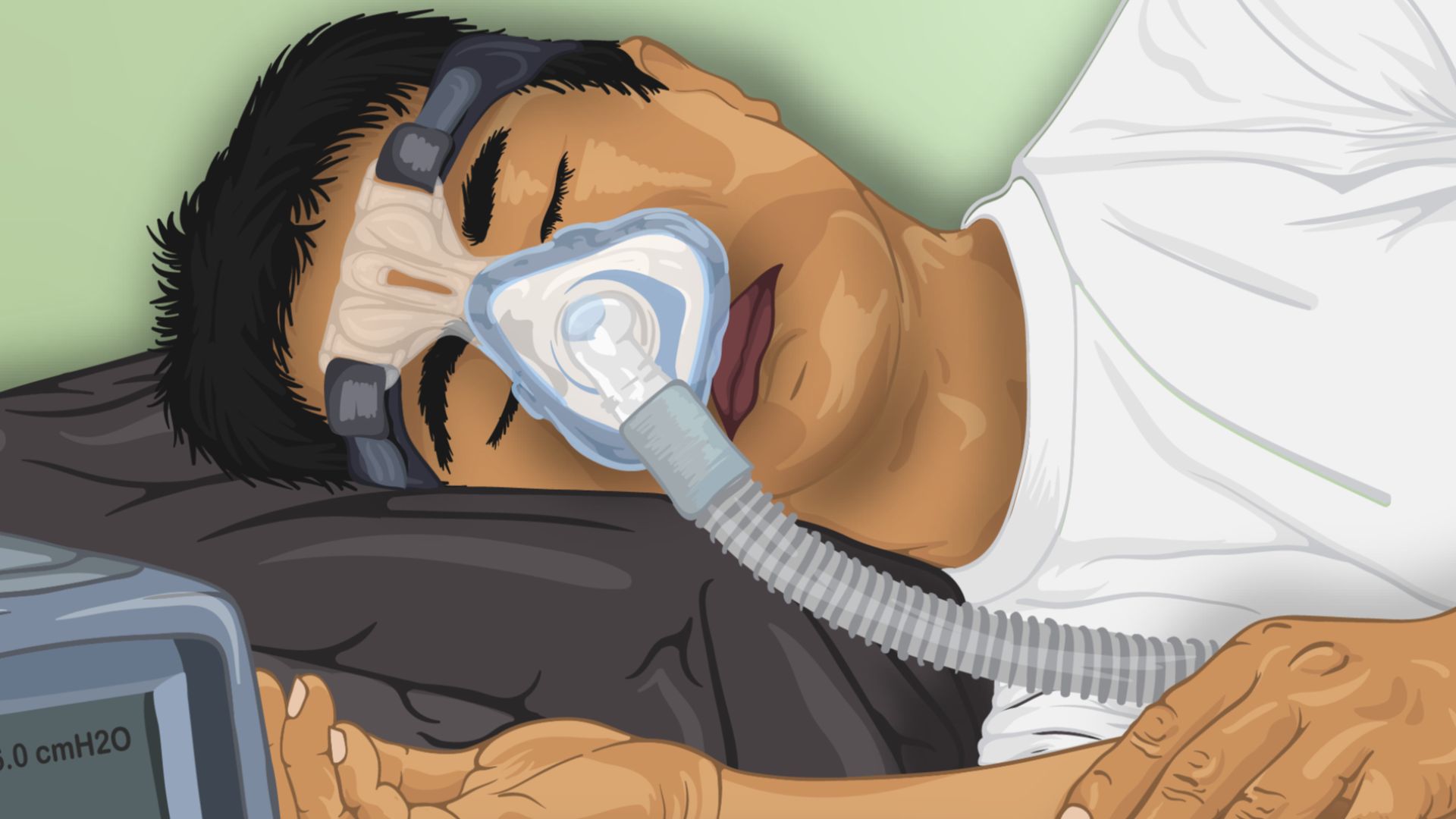 File:Depiction of a Sleep Apnea patient using a CPAP machine.png