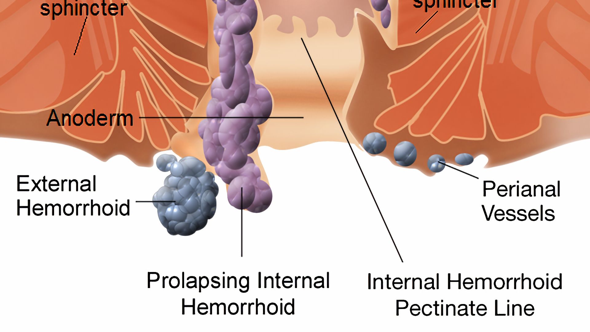 File:Internal and external hemorrhoids.png