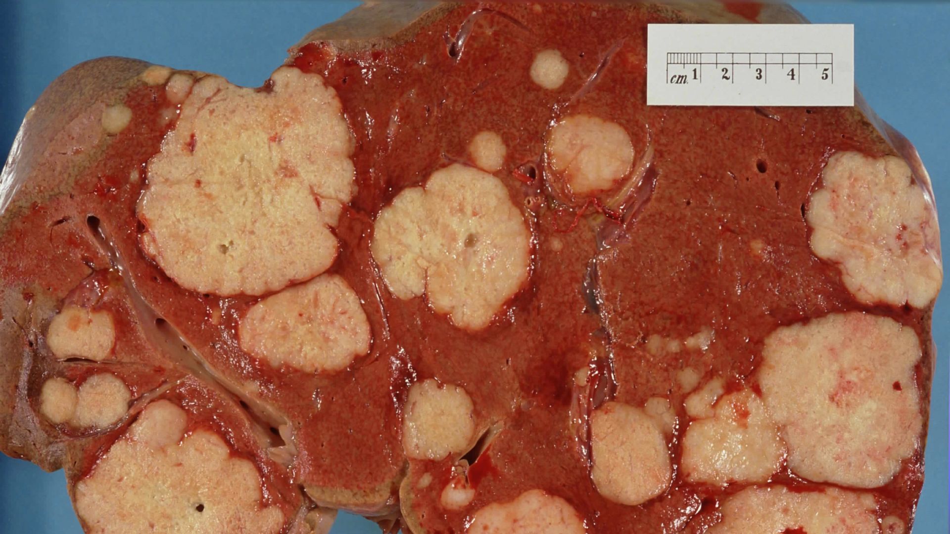File:Secondary tumor deposits in the liver from a primary cancer of the pancreas.jpg