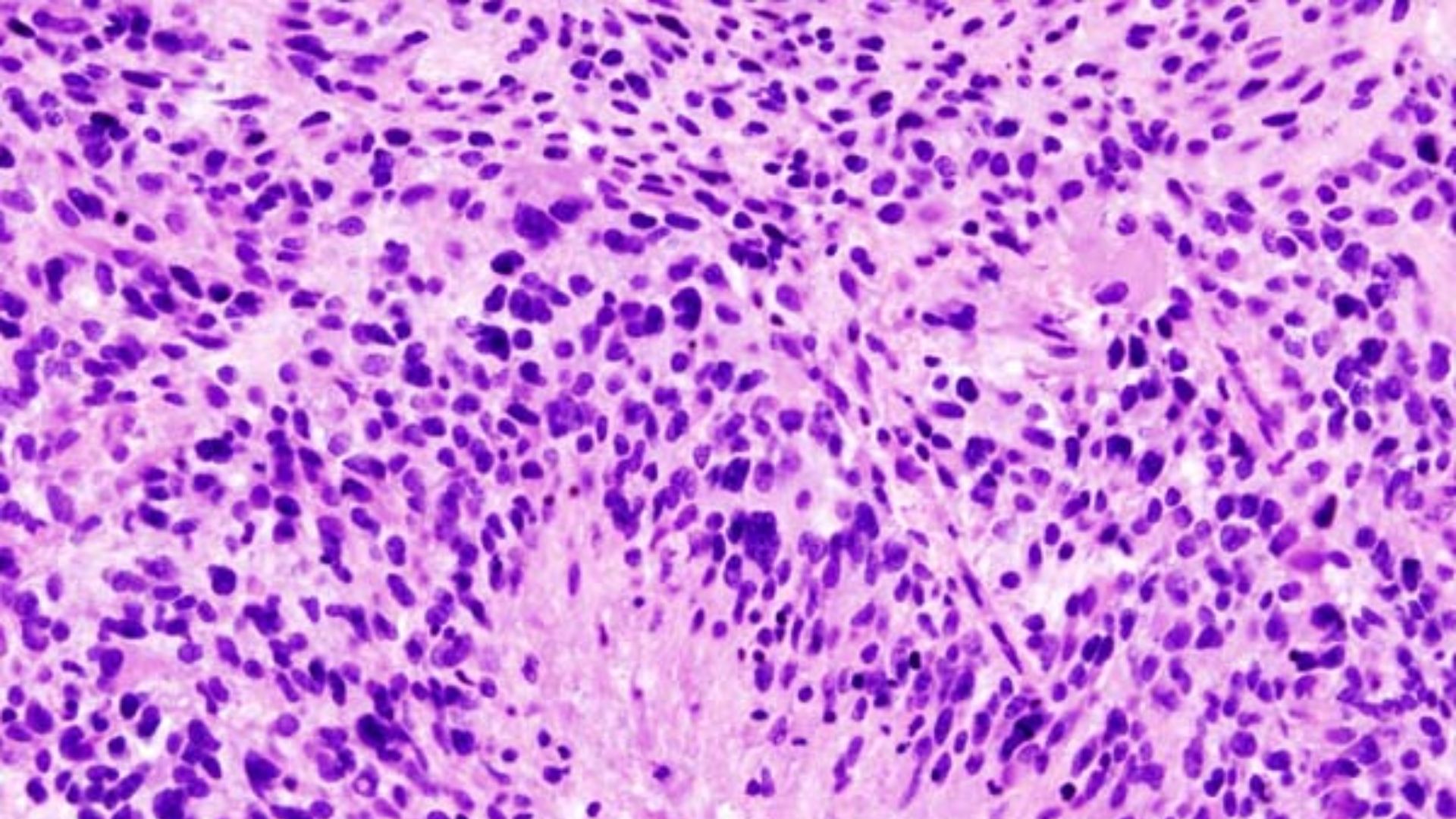 File:Glioblastoma (1).jpg