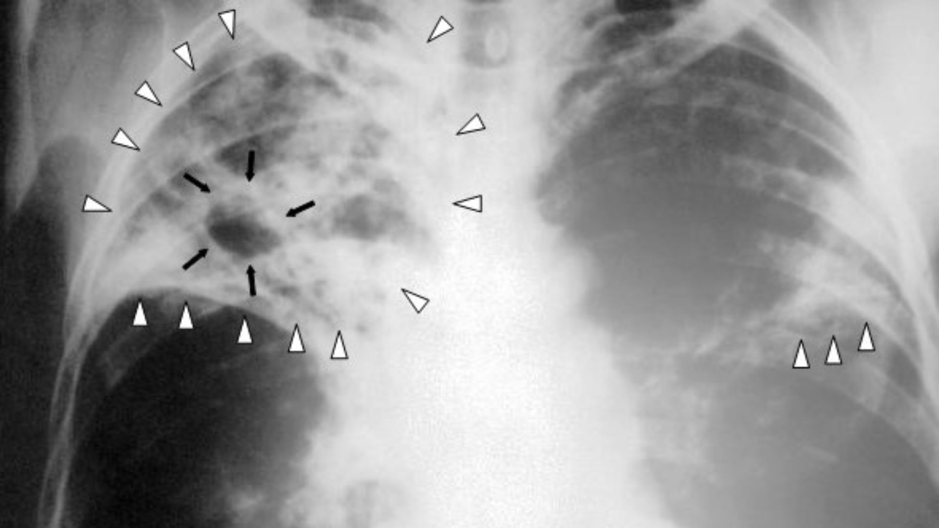 File:Tuberculosis-x-ray-1.jpg