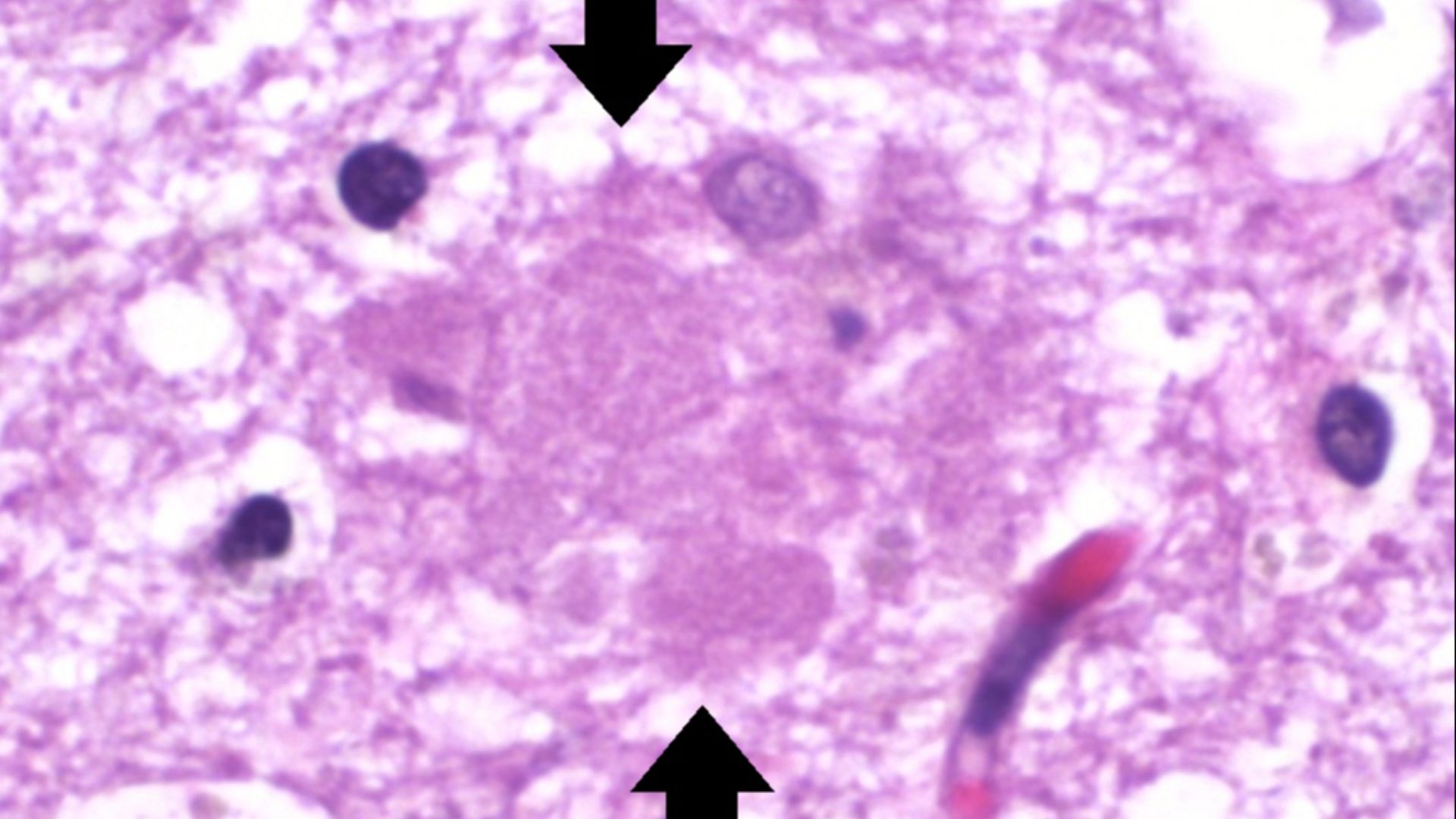 File:Histopathology of amyloid plaque in Alzheimer's disease - annotated.jpg