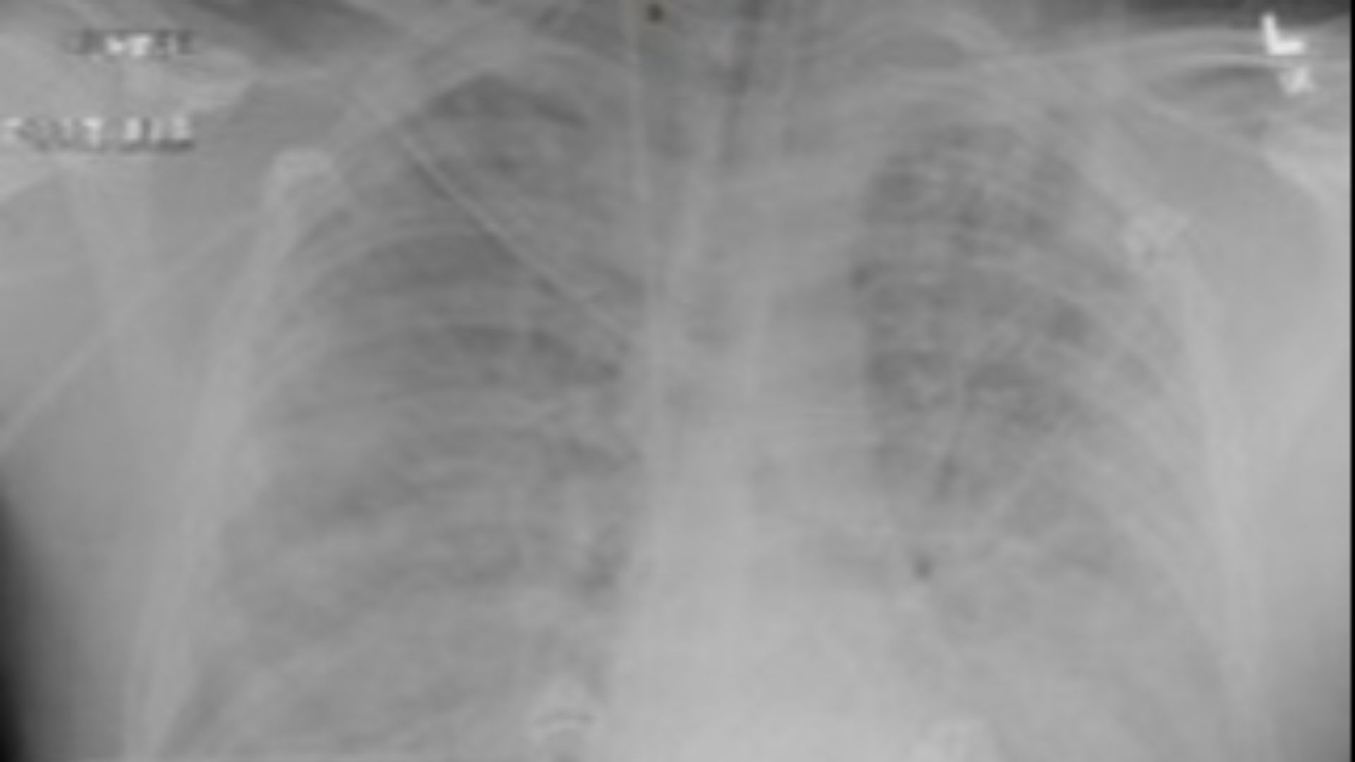 File:Radiographic progression of hantavirus pulmonary syndrome in patient (cropped a).jpg