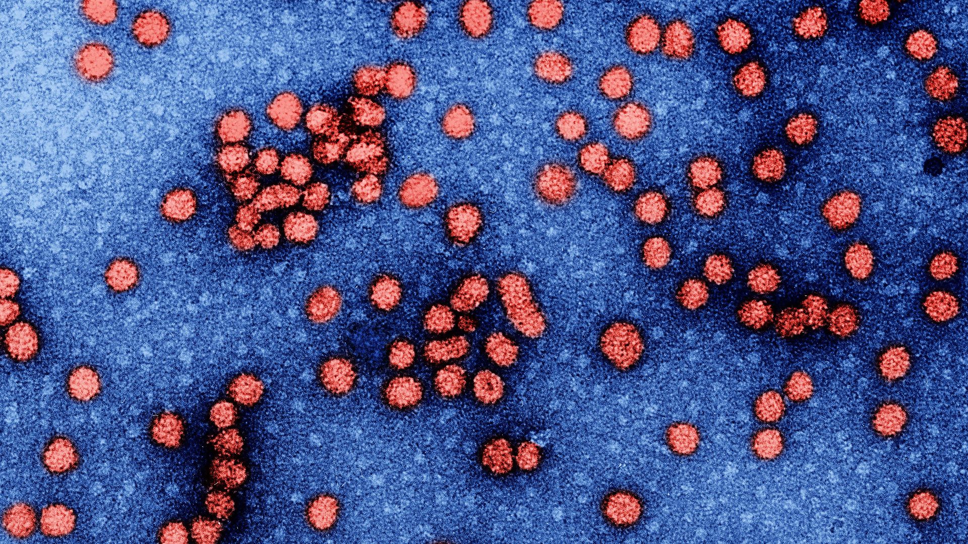 File:Hepatitis b.jpg