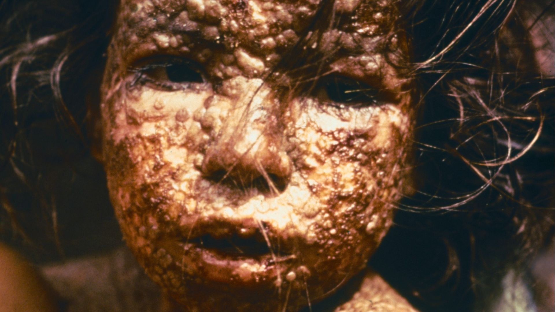 File:Child with Smallpox Bangladesh.jpg