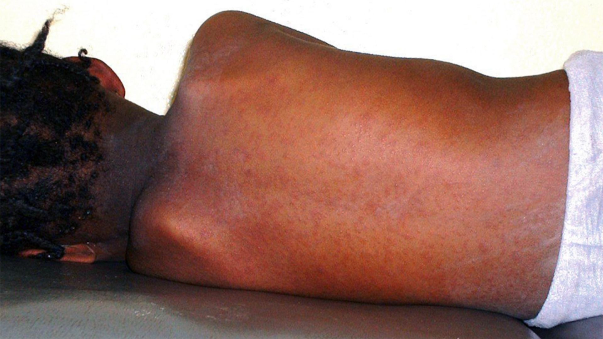 File:Measles in African Child 3.JPG