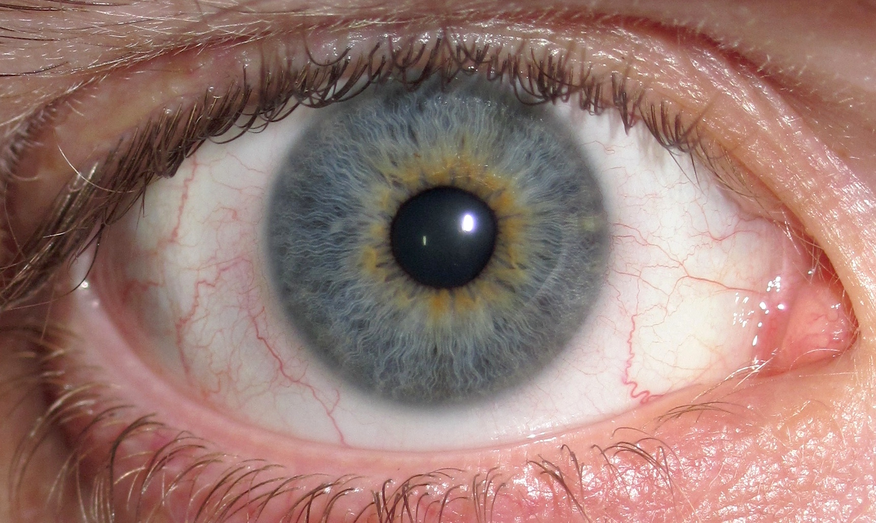 File:Eye Central Heterochromia crop and lighter.jpg