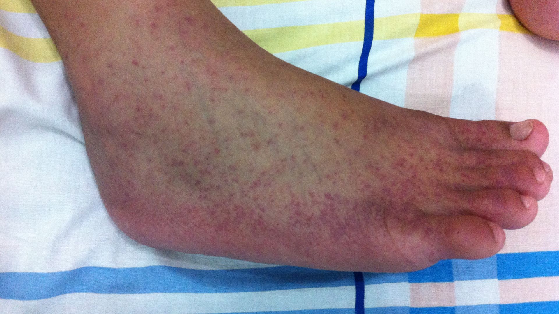 File:2012-01-09 Chikungunya on the right feet at The Philippines.jpeg