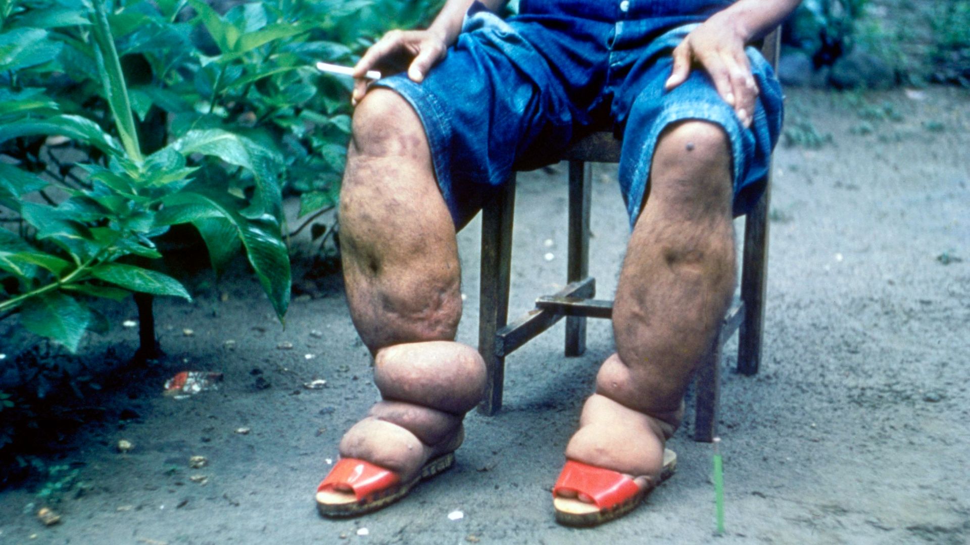 File:Elephantiasis.jpg