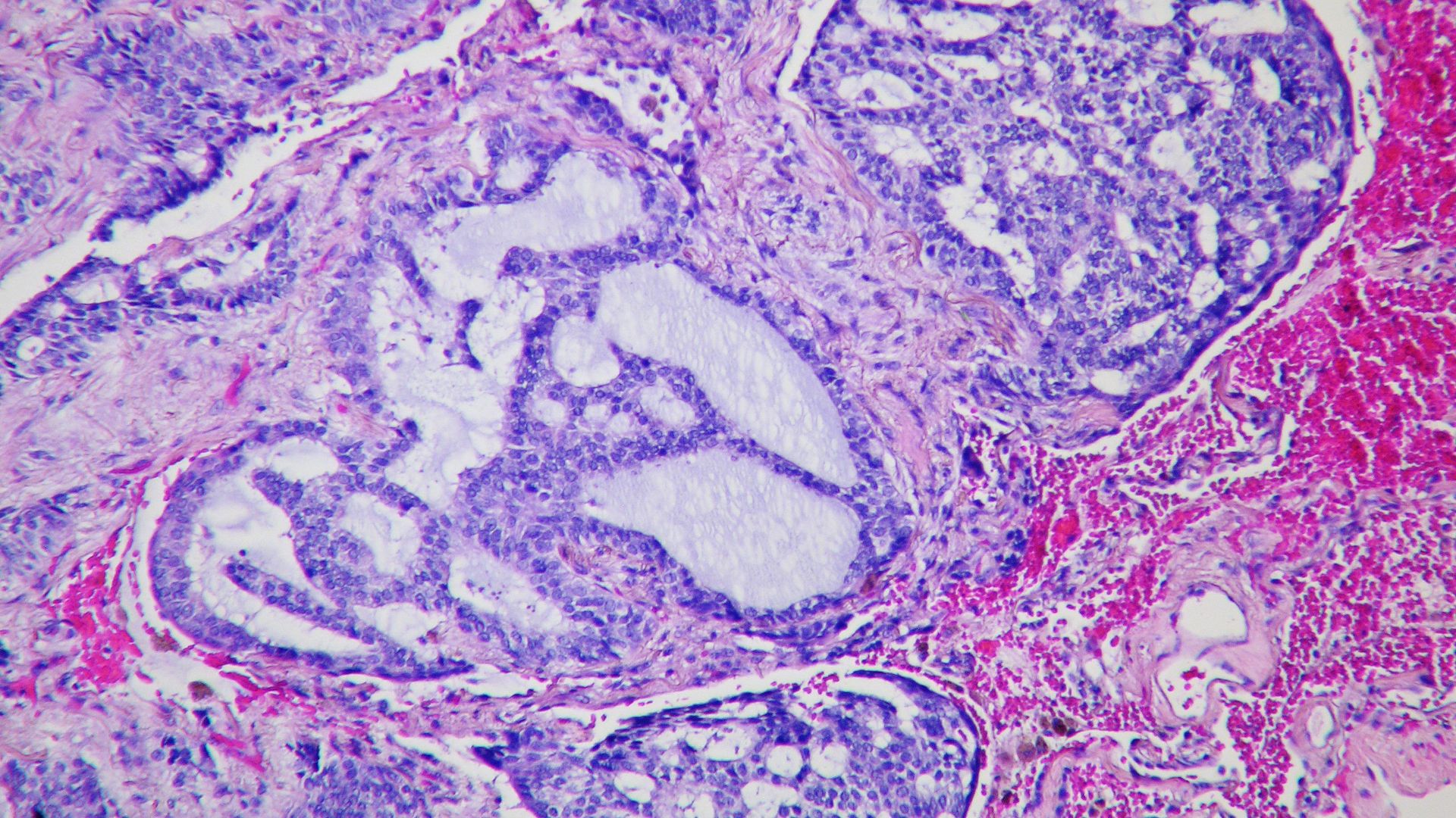 File:Basaloid squamous cell carcinoma Case 275 Lobectomy (9574444174).jpg