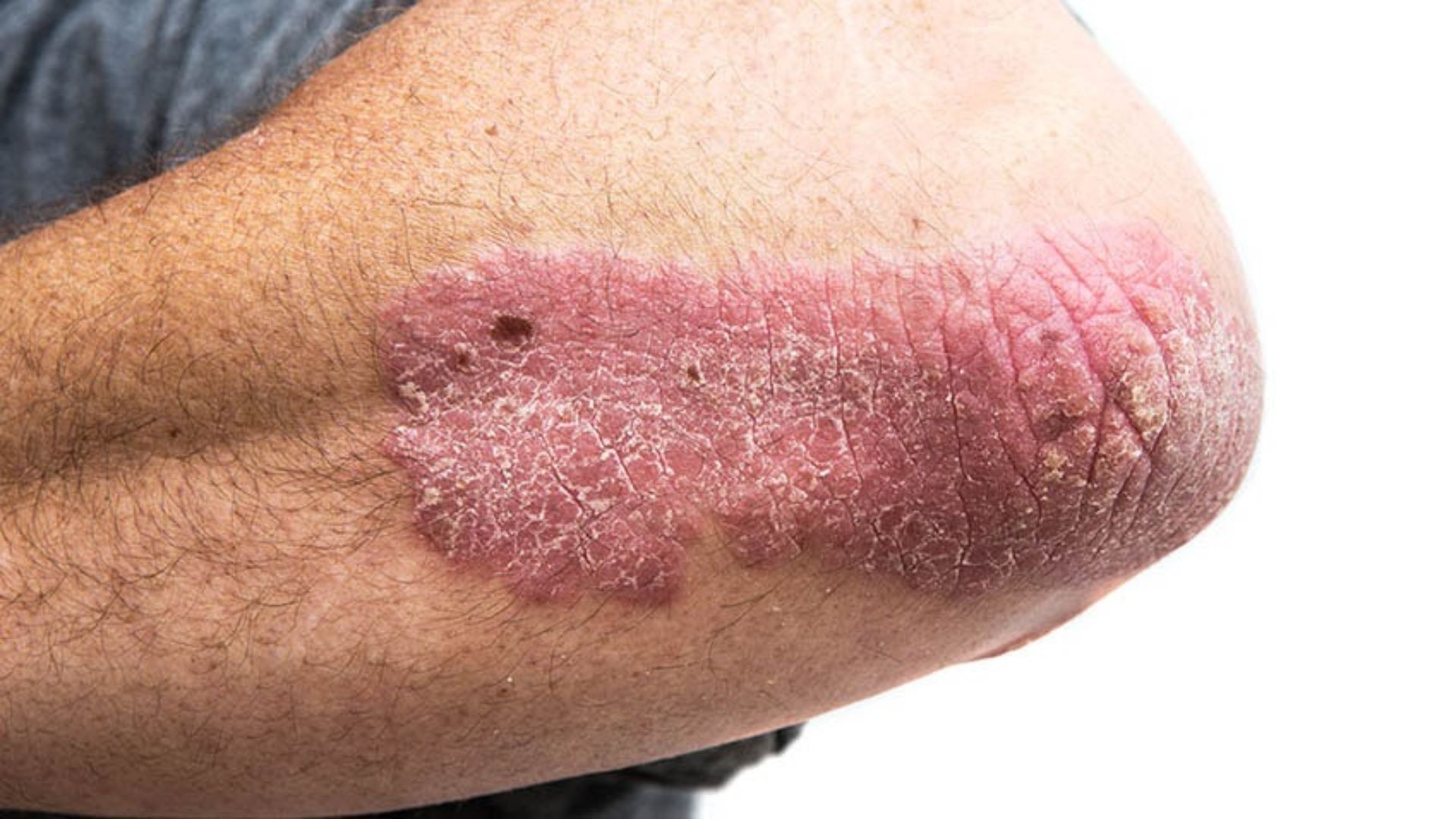 File:Psoriasis on elbow.jpg