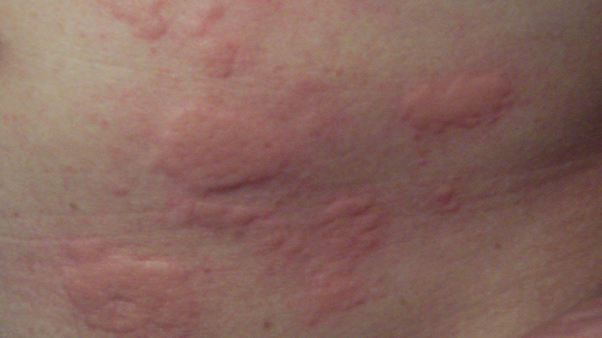 File:Rash.jpg