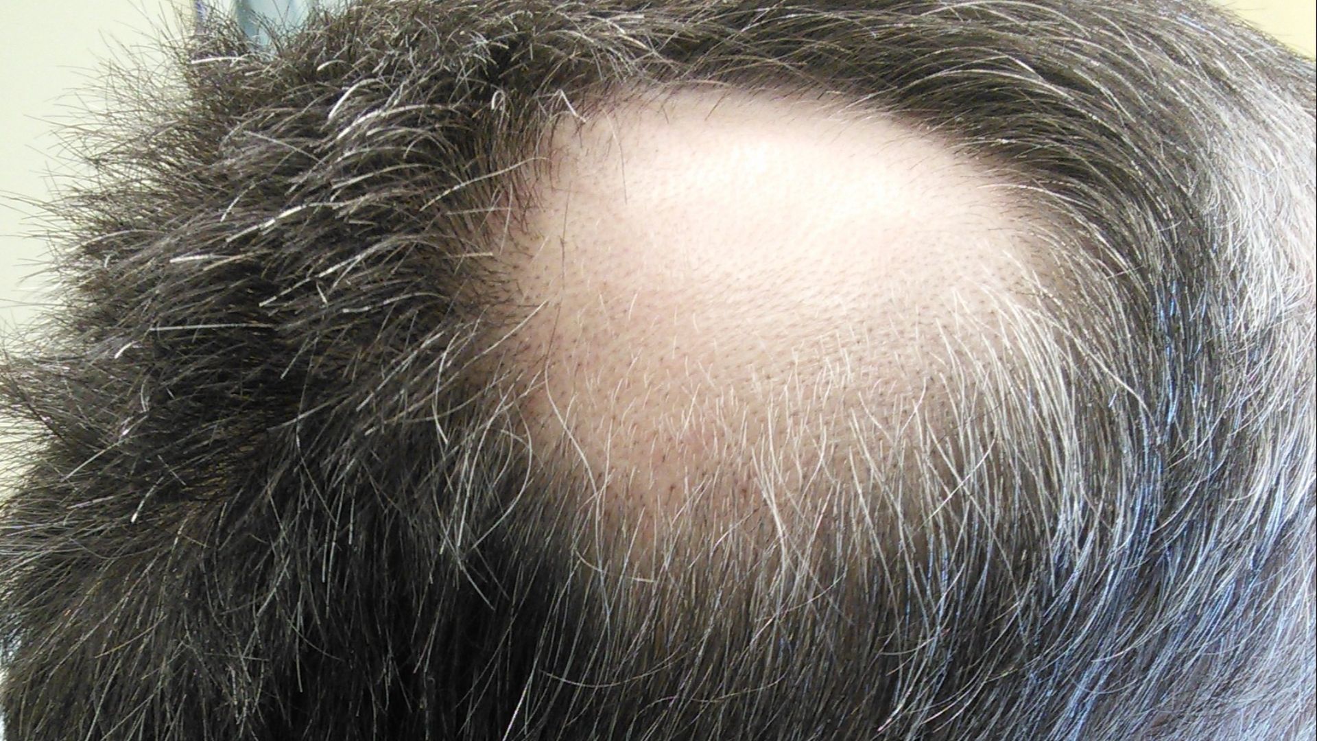 File:Alopecia areata 2.jpg