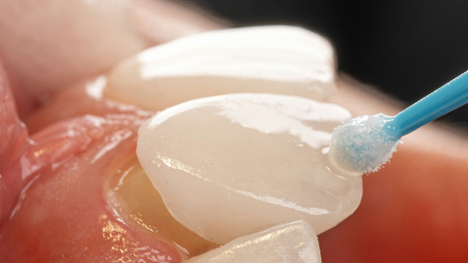 a tooth with a blue toothbrush in it